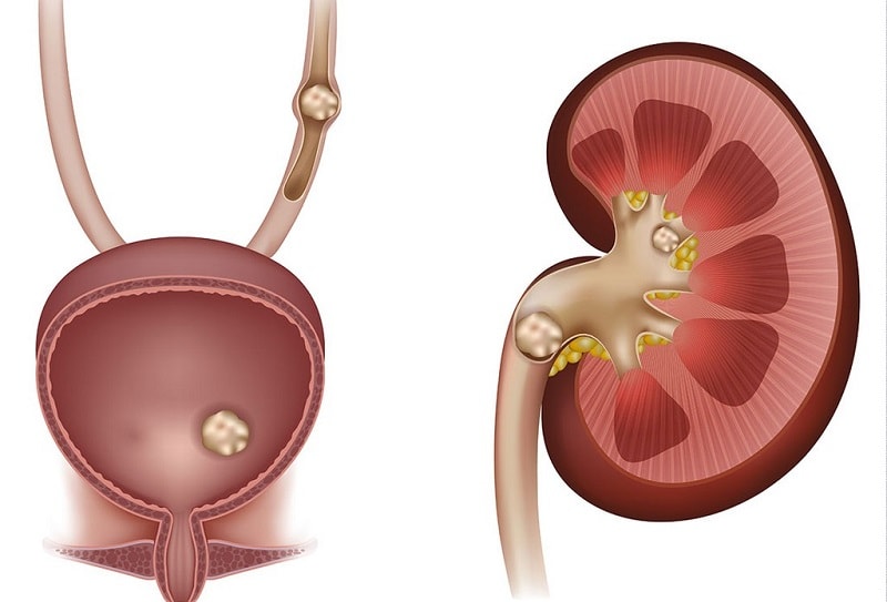 راهکارهای ساده برای دفع سنگ کلیه | با این راه ها از شر سنگ کلیه خلاص شو