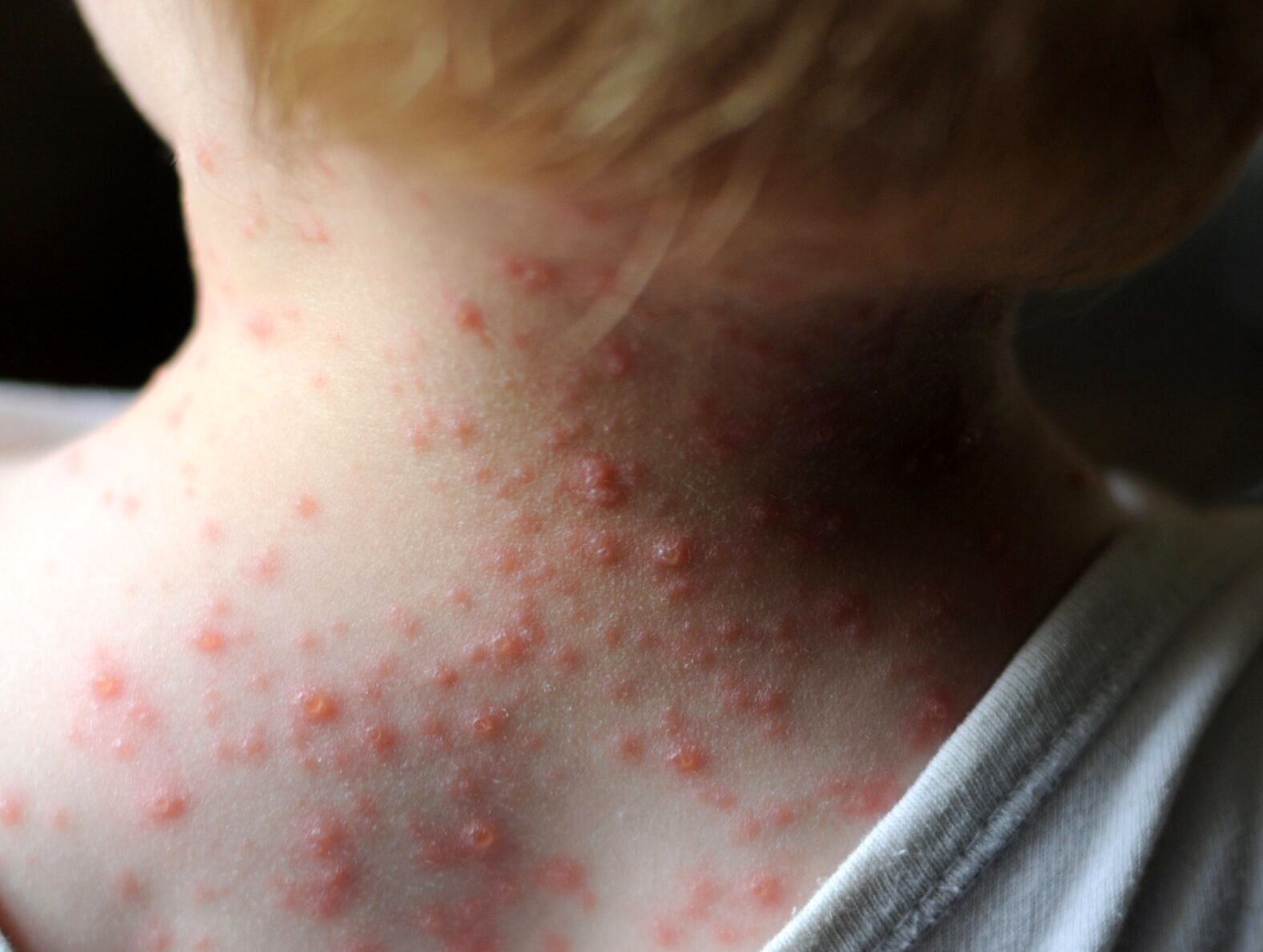 هشدار مهم؛ مصرف این داروها در زمان ابتلا به آبله مرغان کُشنده است